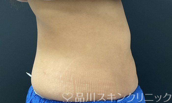 症例NO.74641のAFTER写真