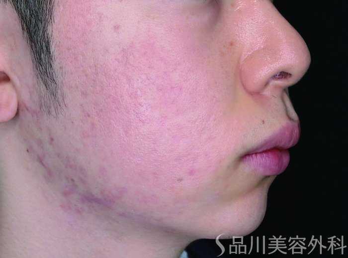 症例NO.72491のAFTER写真