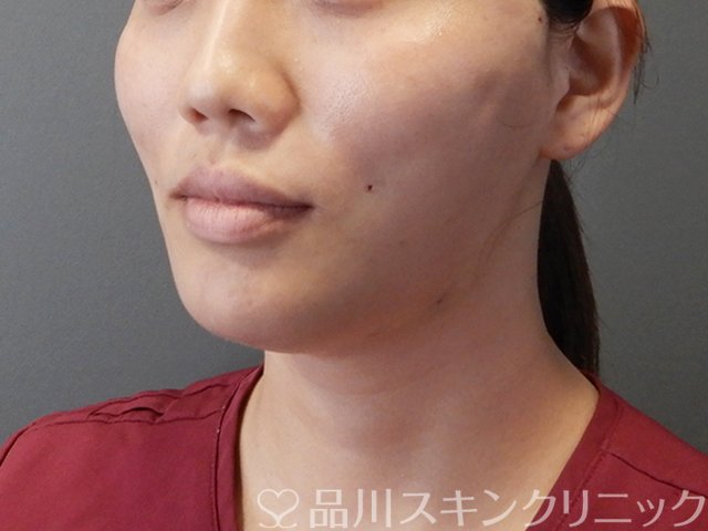 症例NO.65894のAFTER写真