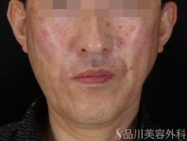 症例NO.70903のAFTER写真