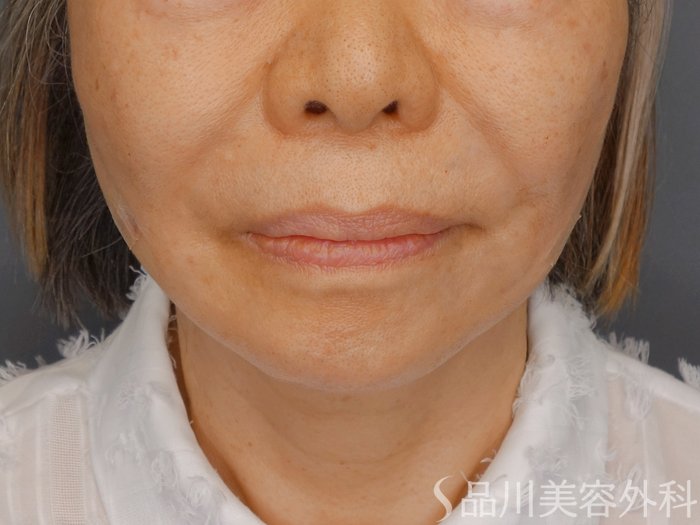 症例NO.70101のAFTER写真