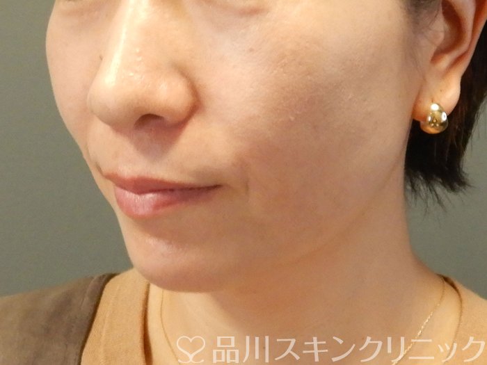 症例NO.62408のBEFORE写真