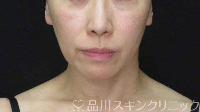 症例NO.72809のBEFORE写真