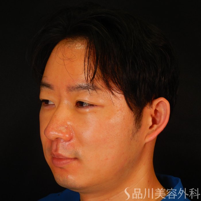 症例NO.66327のBEFORE写真