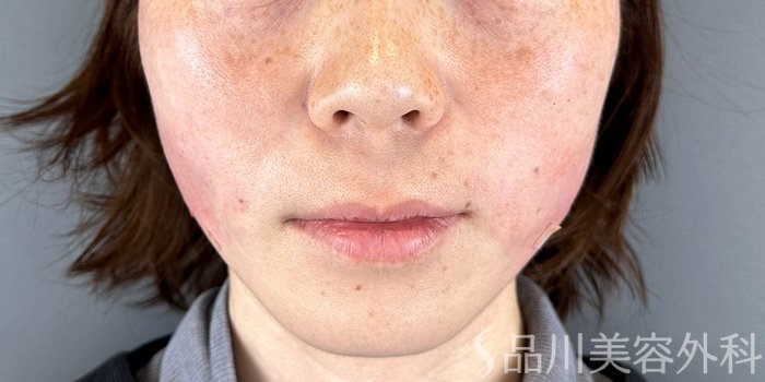 症例NO.69171のAFTER写真