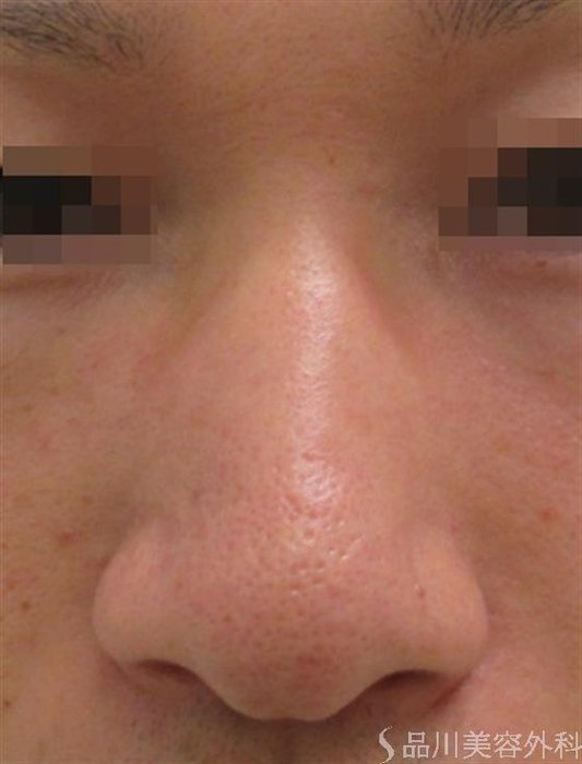症例NO.22954のBEFORE写真