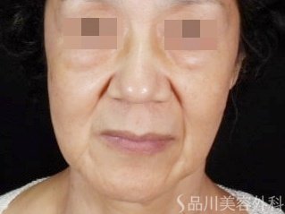 症例NO.71570のBEFORE写真