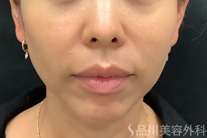 症例NO.71240のAFTER写真