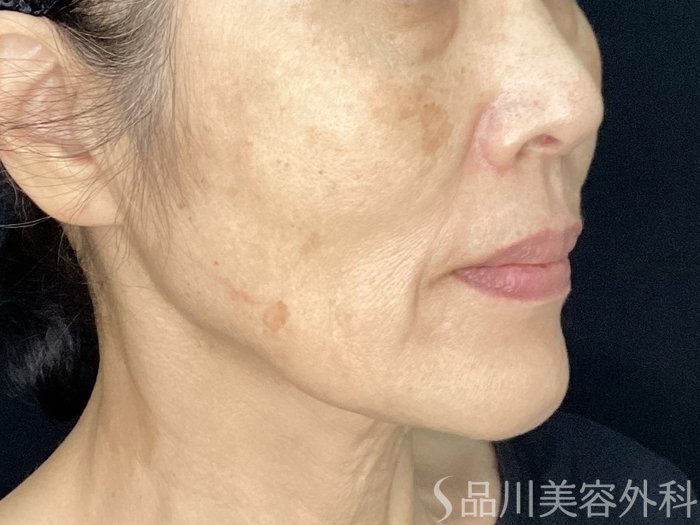 症例NO.71968のBEFORE写真