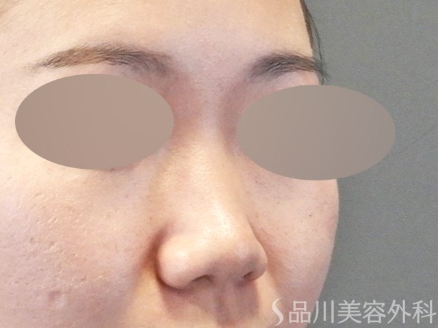 症例NO.64674のBEFORE写真