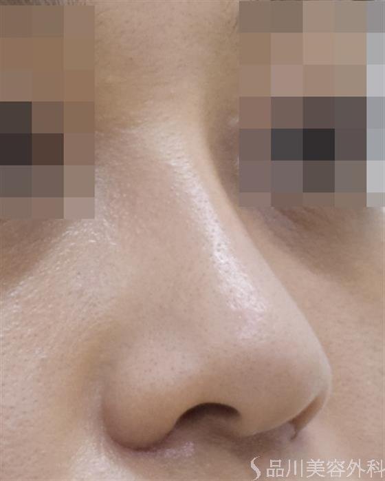 症例NO.50389のAFTER写真