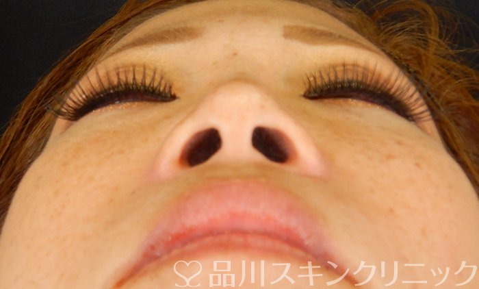 症例NO.67352のBEFORE写真