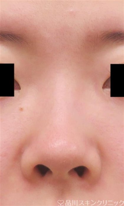 症例NO.58422のBEFORE写真