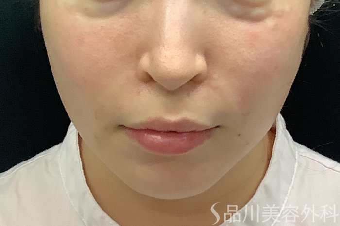 症例NO.71243のAFTER写真