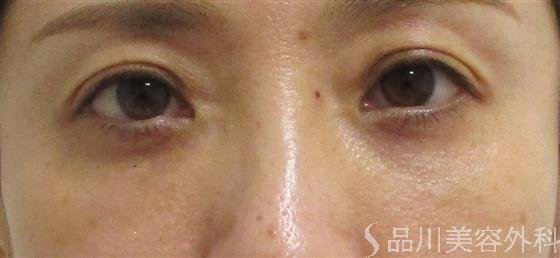 症例NO.55942のAFTER写真