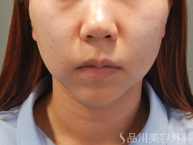 症例NO.74288のBEFORE写真