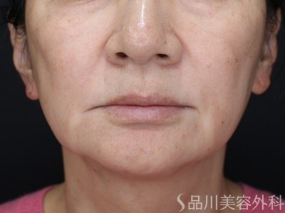 症例NO.69745のBEFORE写真