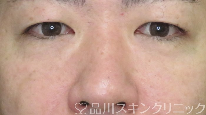 症例NO.70977のAFTER写真