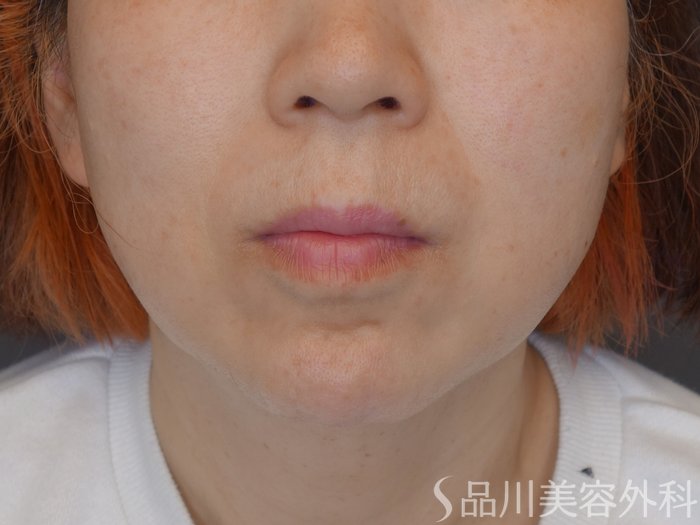 症例NO.70466のBEFORE写真
