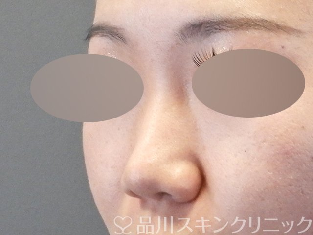 症例NO.64721のBEFORE写真