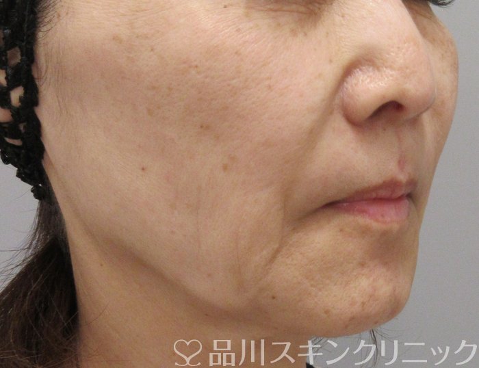 症例NO.72894のBEFORE写真