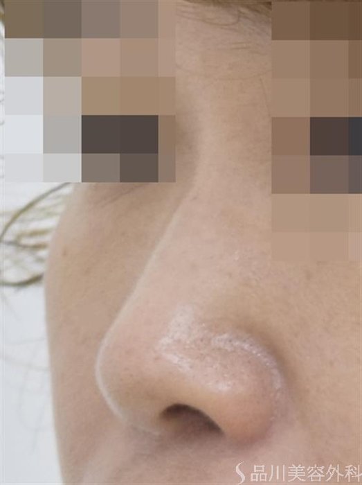 症例NO.50010のBEFORE写真