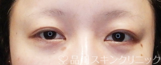 症例NO.74999のBEFORE写真