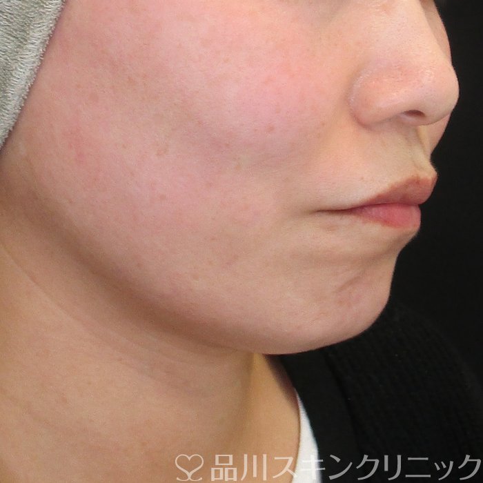 症例NO.73475のAFTER写真