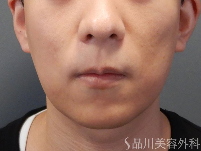 症例NO.73628のAFTER写真