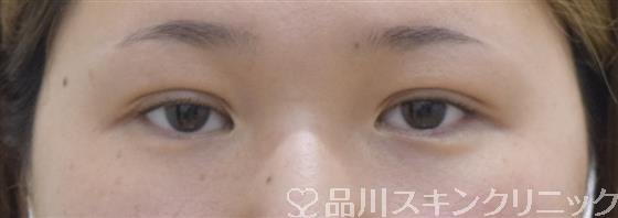 症例NO.53629のAFTER写真