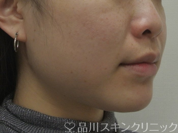 症例NO.69336のBEFORE写真