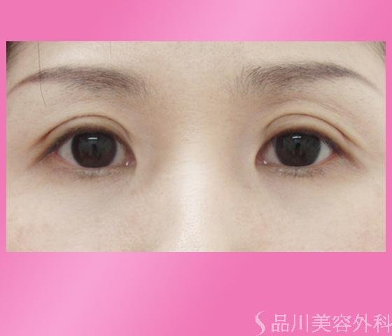 症例NO.1153のAFTER写真