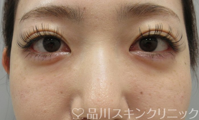 症例NO.74456のAFTER写真