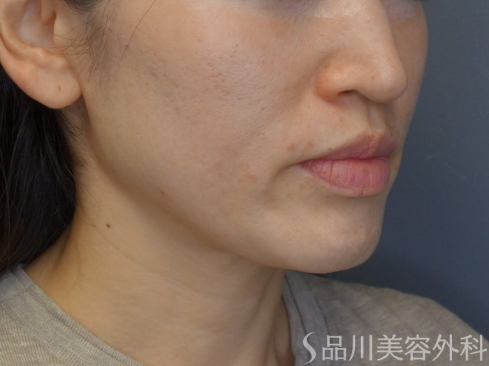 症例NO.74943のBEFORE写真