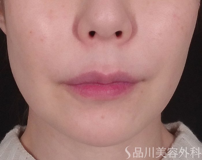 症例NO.69551のBEFORE写真