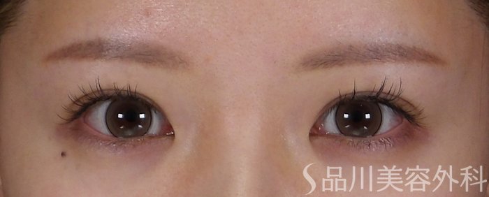症例NO.70133のBEFORE写真