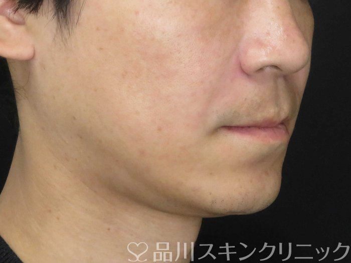 症例NO.66083のAFTER写真