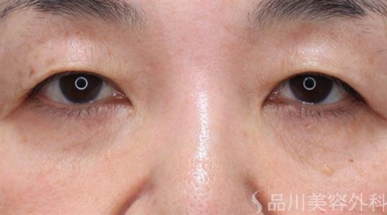 症例NO.61276のAFTER写真