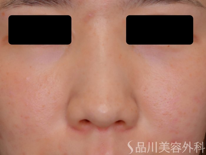 症例NO.68116のBEFORE写真