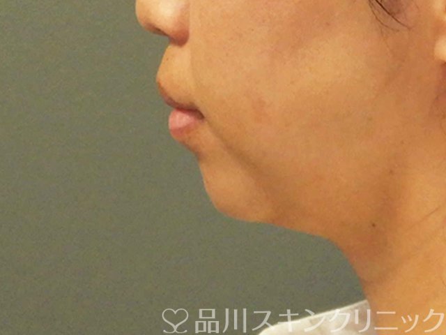症例NO.66918のBEFORE写真