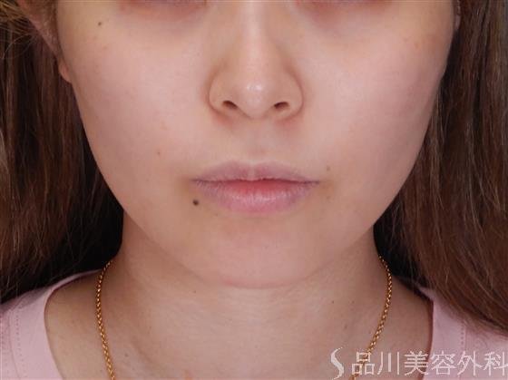 症例NO.59549のAFTER写真