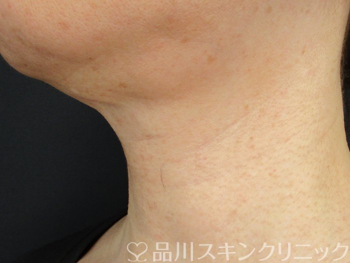 症例NO.74584のBEFORE写真