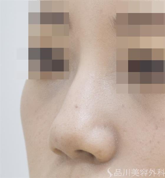 症例NO.45651のBEFORE写真