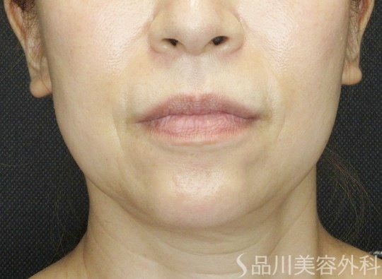 症例NO.71472のBEFORE写真