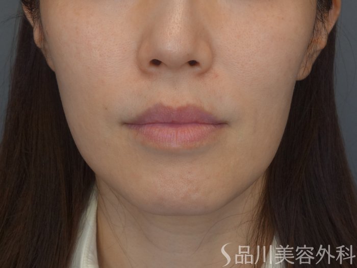 症例NO.71916のBEFORE写真