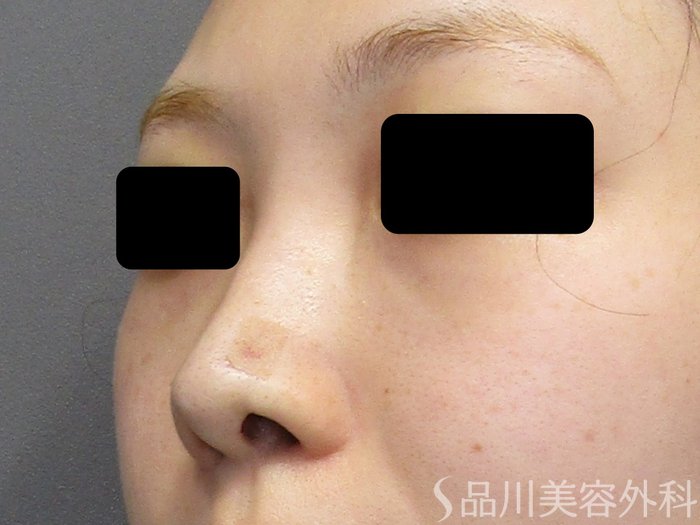 症例NO.75153のAFTER写真