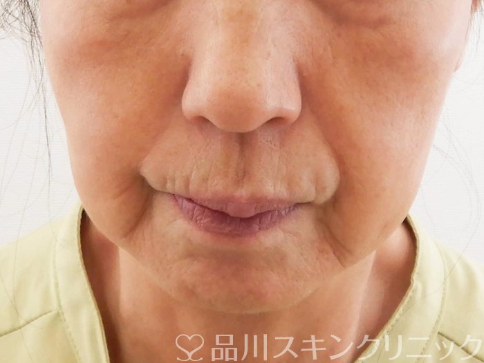 症例NO.62187のBEFORE写真