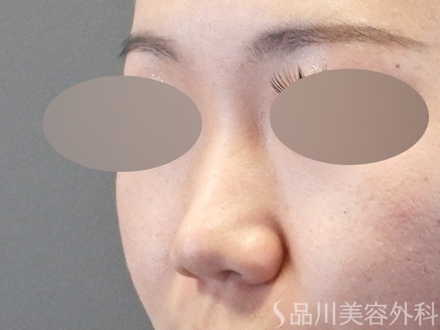 症例NO.64721のBEFORE写真