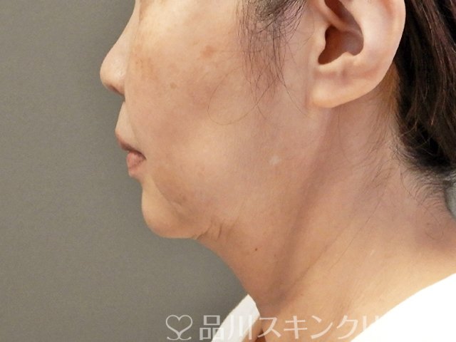 症例NO.66462のBEFORE写真