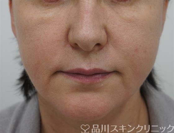 症例NO.38004のAFTER写真